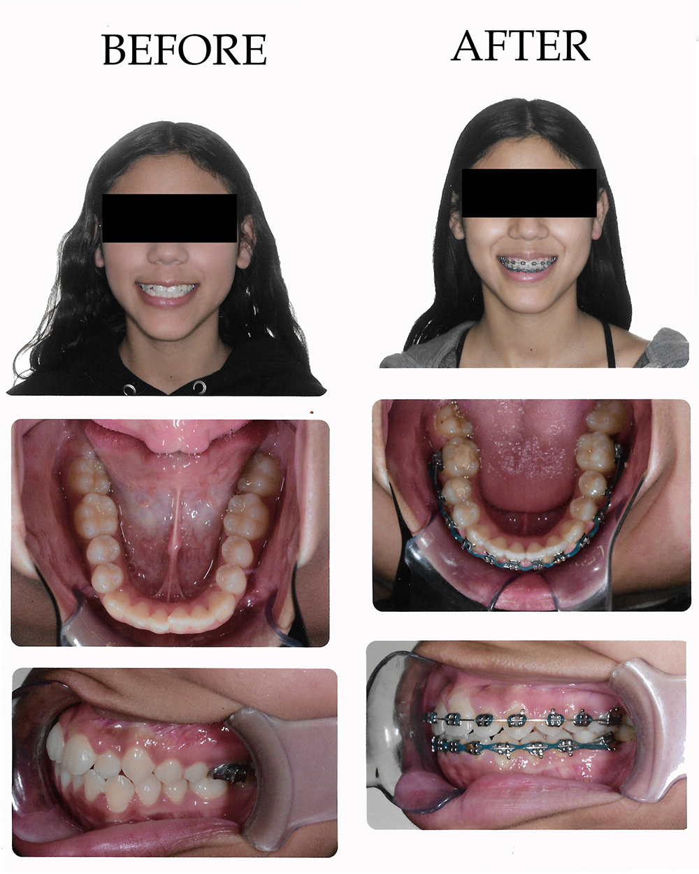 Dentist in Duarte CA Before After Photos