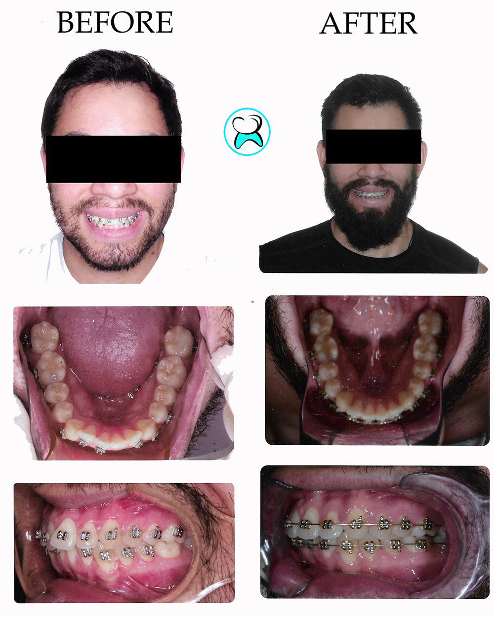 Dentist in Duarte CA Before After Photos