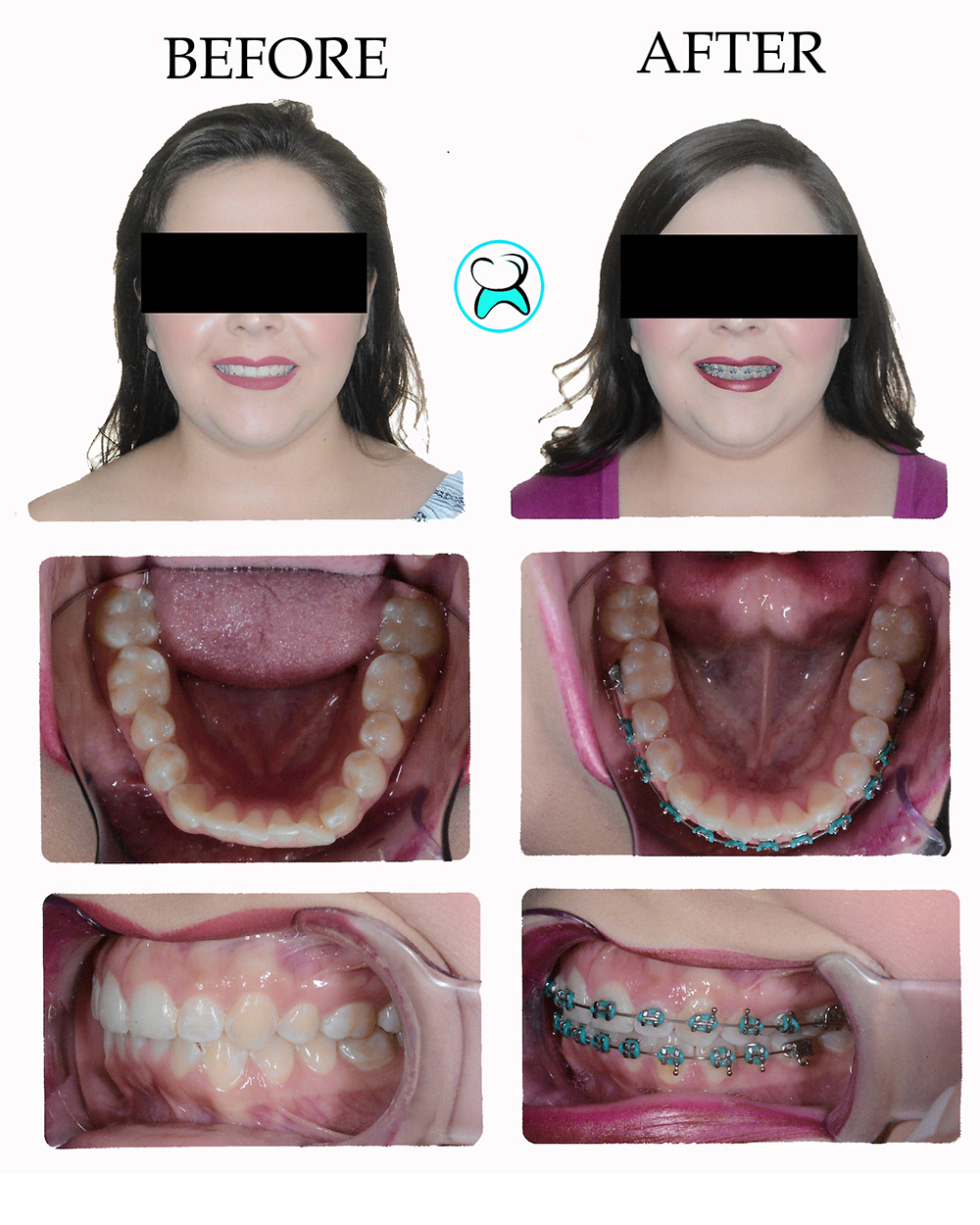 Dentist in Duarte CA Before After Photos