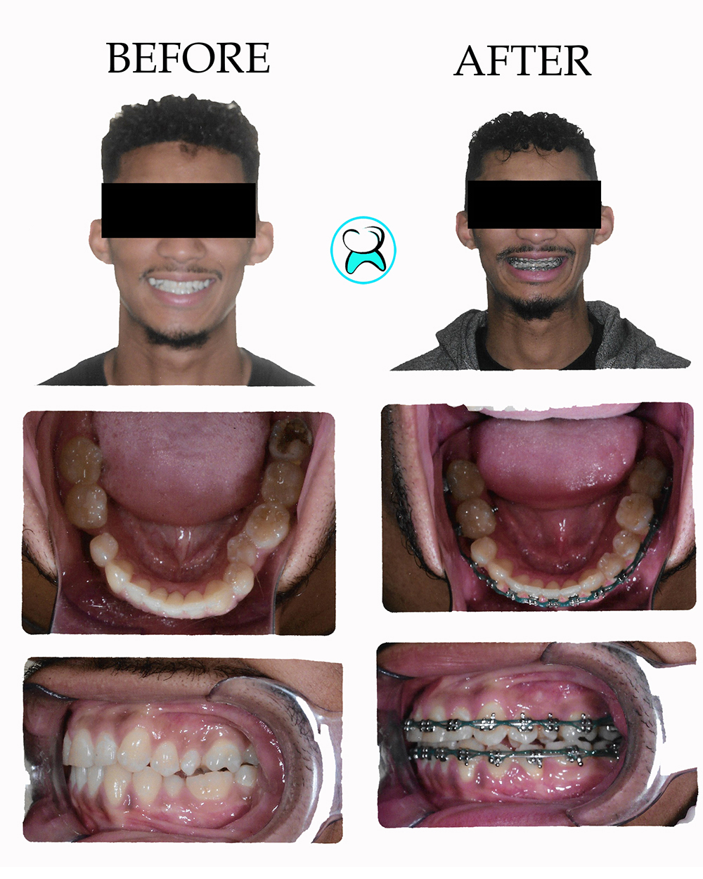 Dentist in Duarte CA Before After Photos