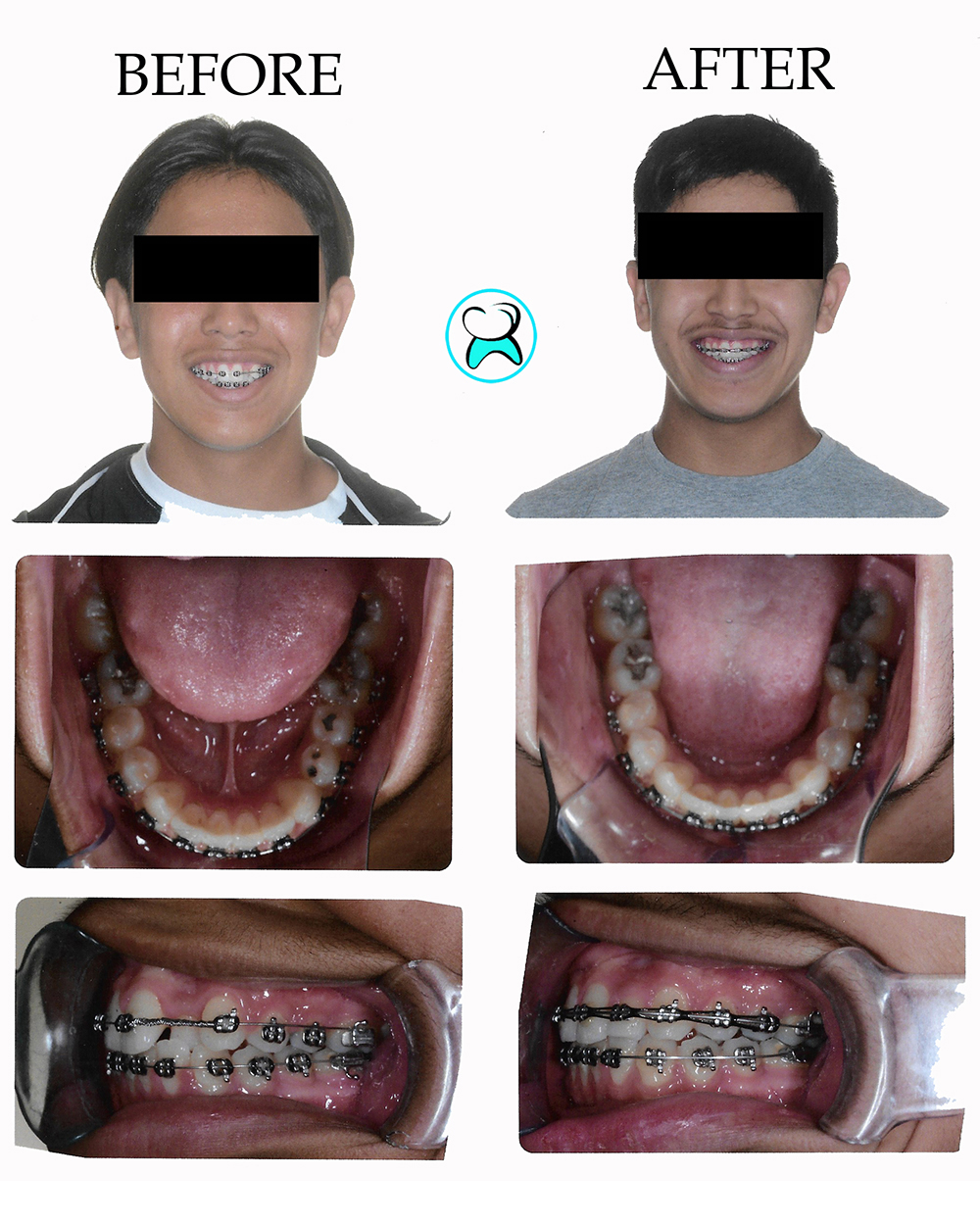 Dentist in Duarte CA Before After Photos